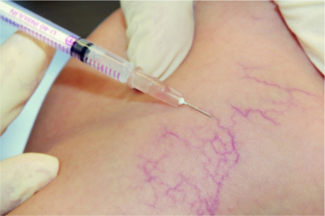 Ceea ce este protejat de sarcină în varicoză - Ceea ce este protejat în varicoza